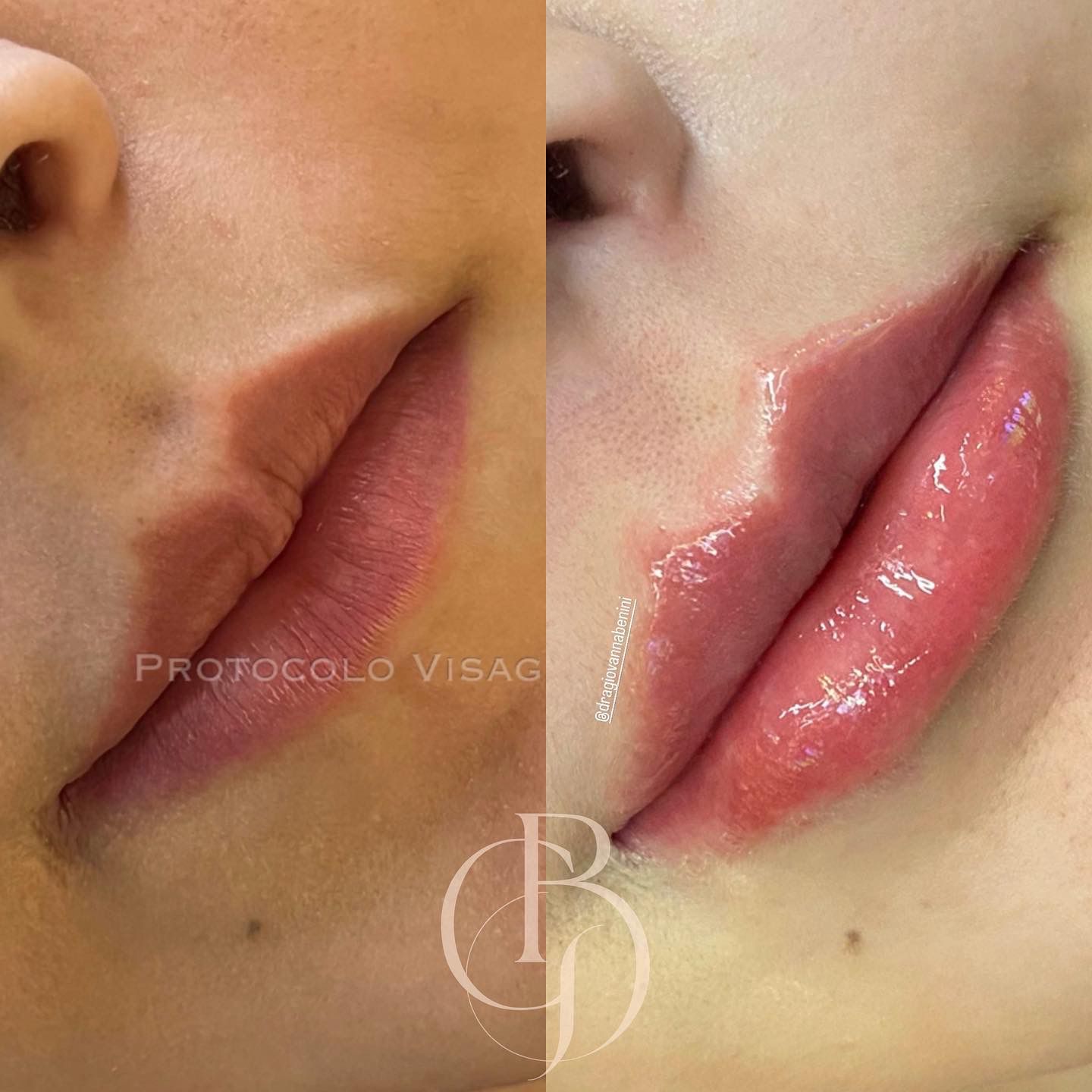 Preenchimento Labial 3